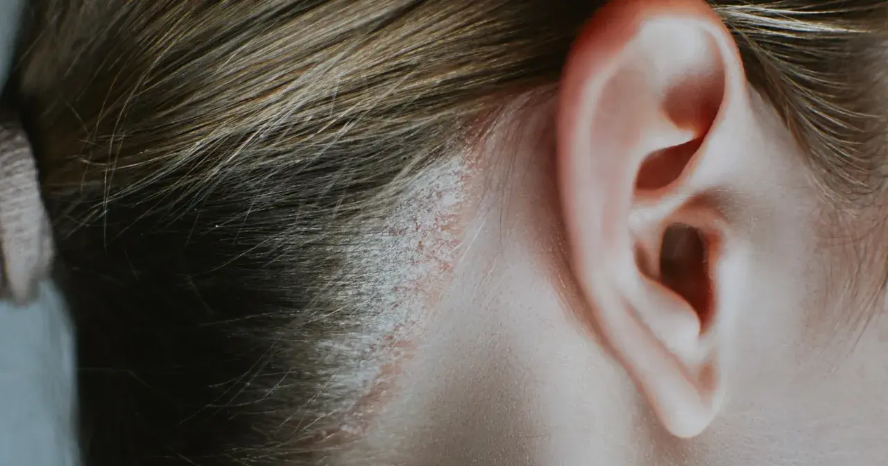 Skóra przy uchu z widocznym łupieżem pstrym i objawami łuszczycy głowy.