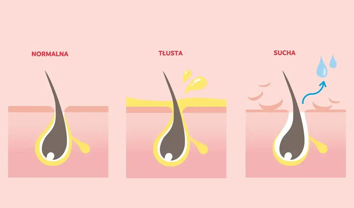 Ilustracja pokazuje normalną, tłustą i suchą skórę głowy. Tłusta skóra może powodować swędzenie i wypadanie włosów.