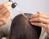 Mężczyzna aplikuje serum na skórę głowy, by zwalczyć nadmierne wydzielanie sebum.