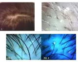 Dwa zdjęcia ukazują skórę głowy z widocznymi zmianami, które mogą powodować dretwienie skory glowy. Dwa kolejne zdjęcia mikroskopowe pokazują szczegóły mieszków włosowych i potencjalne przyczyny problemu.