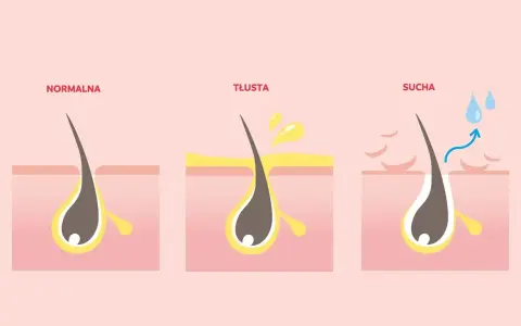 Ilustracja pokazuje normalną, tłustą i suchą skórę głowy. Tłusta skóra może powodować swędzenie i wypadanie włosów.