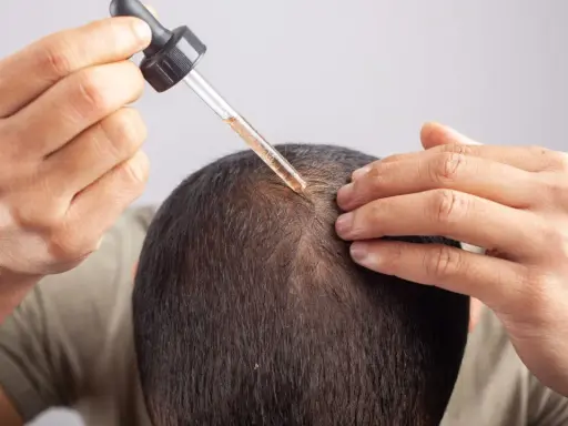Mężczyzna aplikuje serum na skórę głowy, by zwalczyć nadmierne wydzielanie sebum.