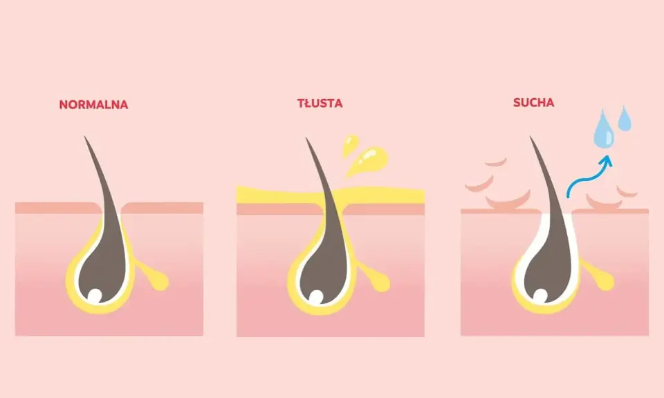 Ilustracja pokazuje normalną, tłustą i suchą skórę głowy. Tłusta skóra może powodować swędzenie i wypadanie włosów.